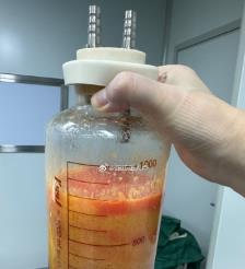 武义县水动力吸脂手术要做多久？